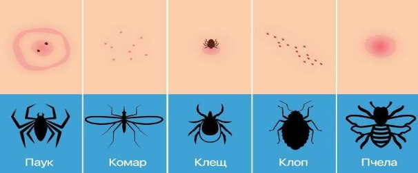 сравнительное фото-коллаж – укус комара / укус блохи / укус клопа